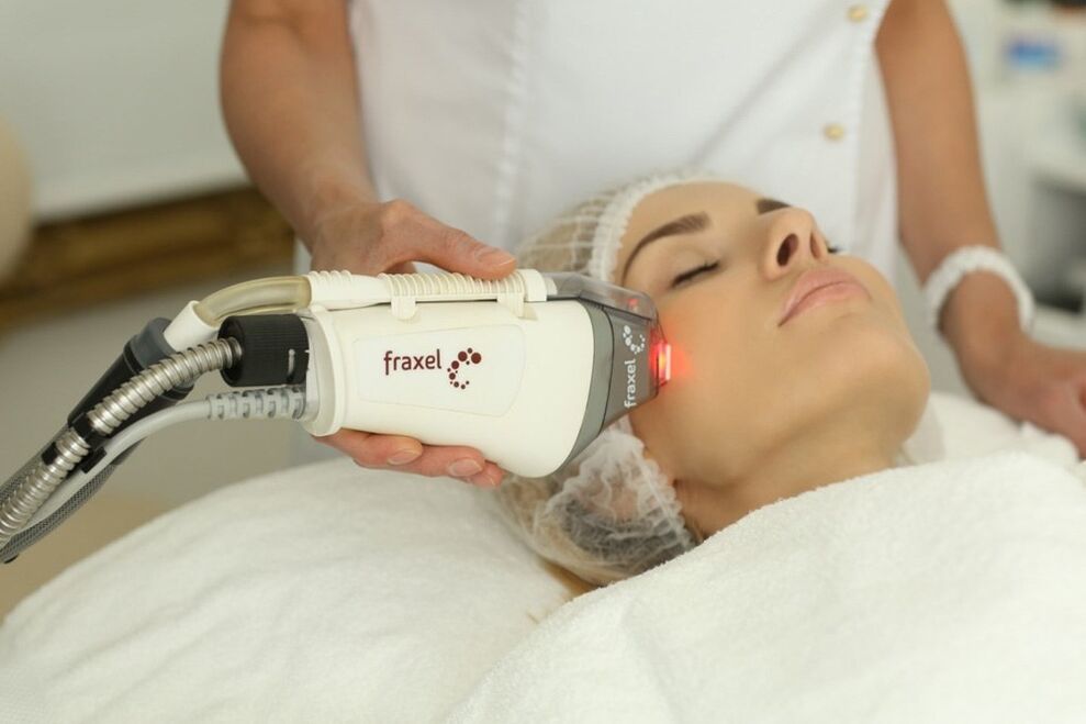 Rajeunissement au laser