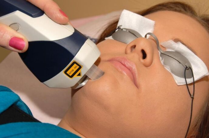 L'effet laser a un effet cumulatif