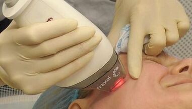 Comment se déroule le rajeunissement fractionné de la peau