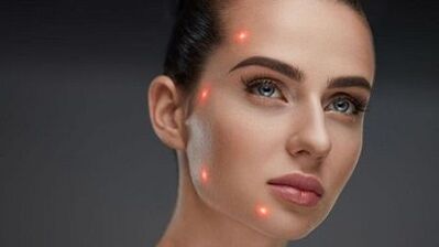 Qu'est-ce que le rajeunissement fractionné de la peau