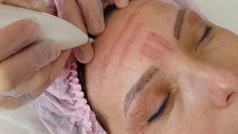 Rajeunissement du visage au plasma