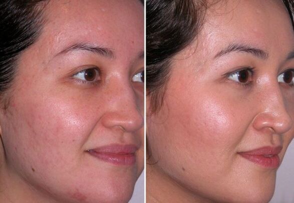 cours de microdermabrasion