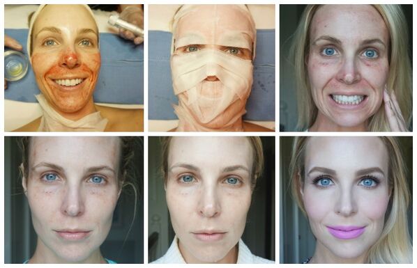 Étapes de guérison de la peau du visage après un lifting plasma réussi