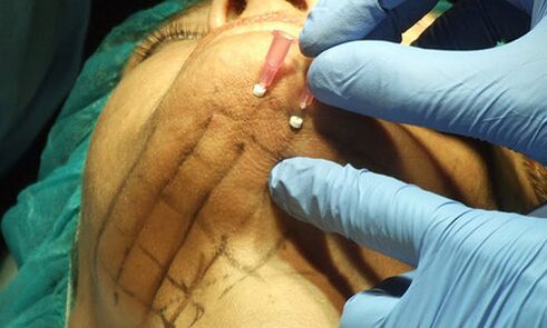 Le lifting au fil, une technique mini-invasive pour le rajeunissement de la peau du visage